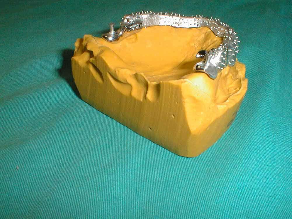 sup_overdenture1.JPG (87943 byte)