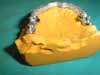 sup_overdenture4 copia.JPG (4797 byte)