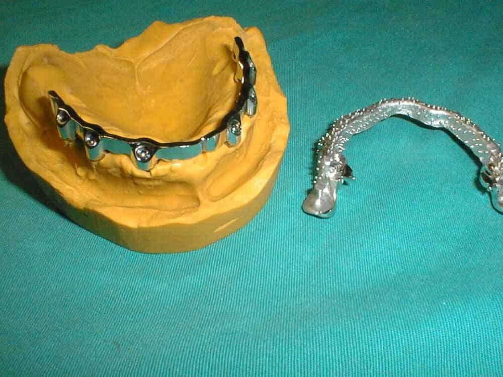 sup_overdenture5.JPG (93148 byte)